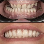 Before and after dental veneers at HALDENT Dental Clinic – smile makeover results