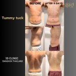 نتائج شد البطن قبل وبعد في ID Clinic Bangkok مع تحسين واضح لشكل البطن