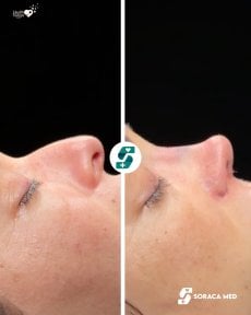 before-after photo rhinoplasty-nose-job