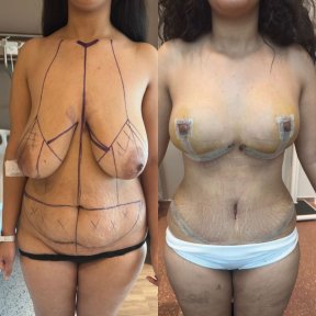 Before and after tummy tuck and breast lift results at Memorial Göztepe Hospital