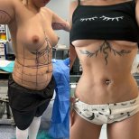 Before and after tummy tuck results at Memorial Göztepe Hospital, visible abdominal contour
