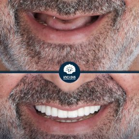before-after photo all-on-6-dental-implants