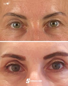 before-after photo blepharoplasty-eyelid