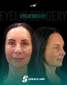 before-after photo blepharoplasty-eyelid