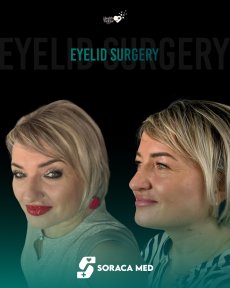 before-after photo blepharoplasty-eyelid