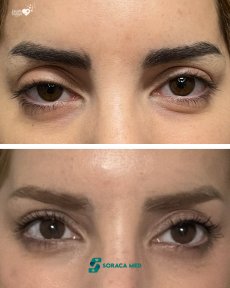 before-after photo blepharoplasty-eyelid