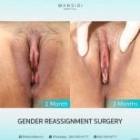 Before and after sex reassignment surgery results at Wansiri Hospital, 1 vs 3 months post-op