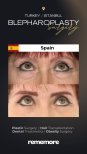 Before and after blepharoplasty results at Memorial Bahçelievler Hospital, eyelid surgery