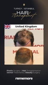 Before and after female hair transplant results at Memorial Bahçelievler Hospital, fuller hair