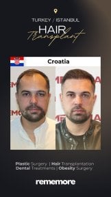 Before and after male hair transplant results at Memorial Bahçelievler Hospital, fuller hairline