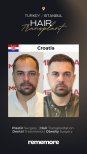 Before and after male hair transplant results at Memorial Bahçelievler Hospital, fuller hairline