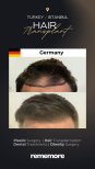 Before and after female hair transplant results at Memorial Bahçelievler Hospital, fuller hairline