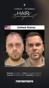 Before and after male hair transplant results at Memorial Bahçelievler Hospital, fuller hairline