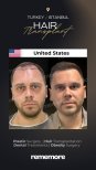 Before and after male hair transplant results at Memorial Bahçelievler Hospital, fuller hairline