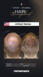 Before and after female hair transplant results at Memorial Bahçelievler Hospital, fuller crown