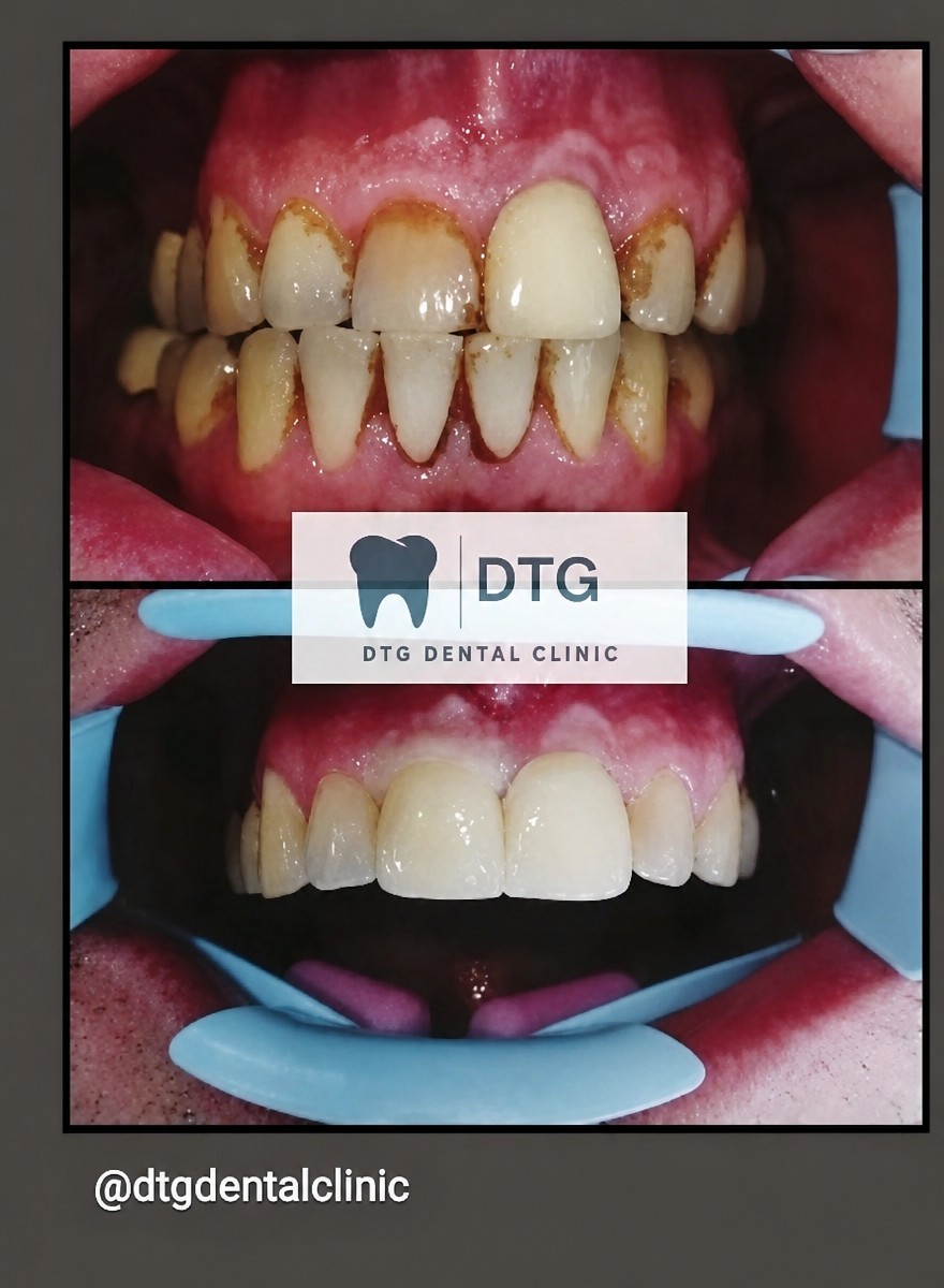 Resultados de blanqueamiento dental láser antes y después en DTG Dental Clinic – sonrisa más blanca