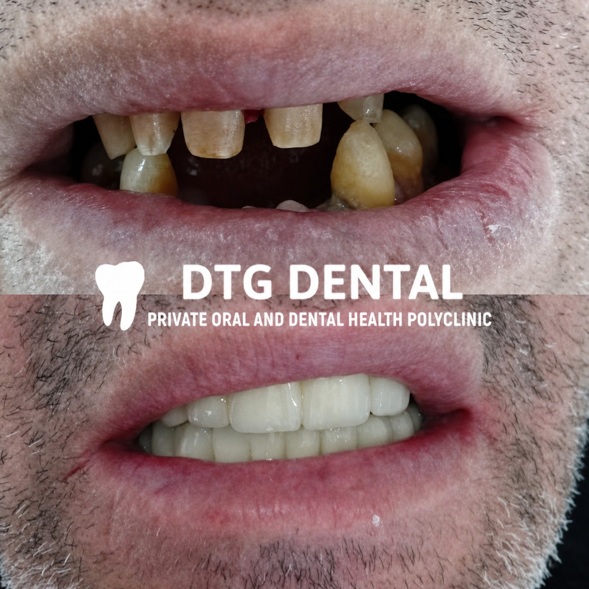 Resultado antes y después de prótesis fijas de zirconia sobre implantes en DTG Dental
