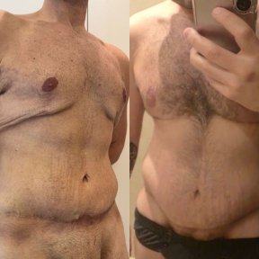 before-after photo post-bariatric-plastic-surgery