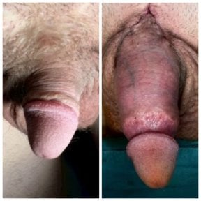 before-after photo penis-enlargement