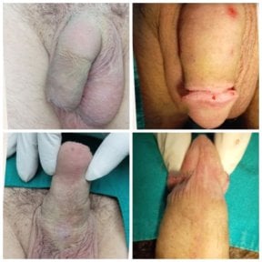 before-after photo penis-enlargement