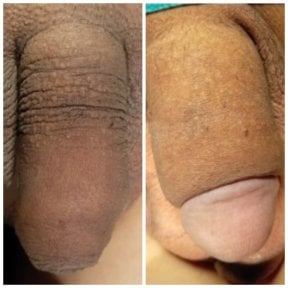 before-after photo penis-enlargement