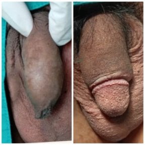 before-after photo penis-enlargement
