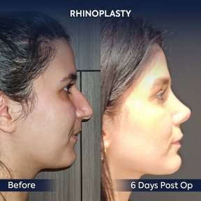 before-after photo rhinoplasty-nose-job