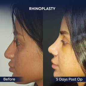 before-after photo rhinoplasty-nose-job