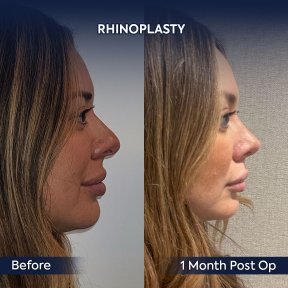 before-after photo rhinoplasty-nose-job