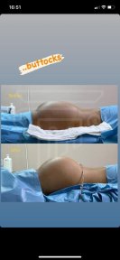before-after photo liposakciya-360