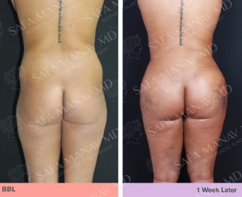 before-after photo liposakciya-360