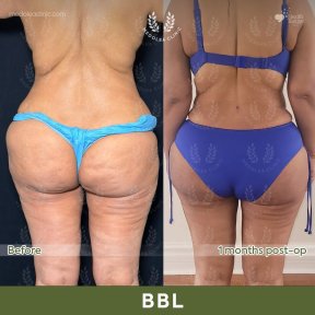 before-after photo liposakciya-360