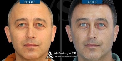 before-after photo blepharoplasty-eyelid