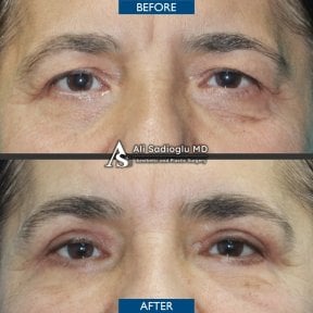 before-after photo blepharoplasty-eyelid