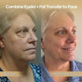 before-after photo blepharoplasty-eyelid