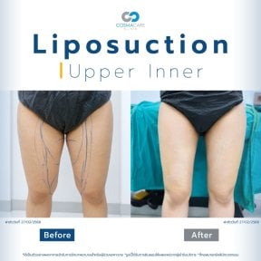 Before and after Vaser liposuction results for upper inner thighs at Cosmacare clinic