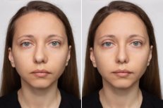 Before and after blepharoplasty results, upper eyelid correction with natural appearance