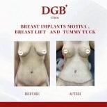 Before and after breast lift, implants, and tummy tuck results at DGB Clinic