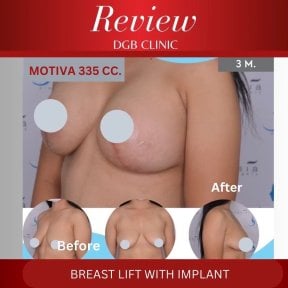 Before and after breast lift with implant at DGB Clinic, Motiva 335cc, visible lift result