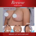 Before and after breast lift with implant at DGB Clinic, Motiva 335cc, visible lift result