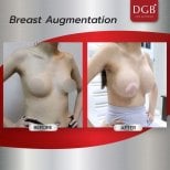 Before and after breast augmentation results at DGB Clinic, enhanced breast volume and shape