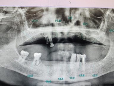 Radiographie d’implant dentaire à Dential Dental Clinic montrant mâchoire et résultat