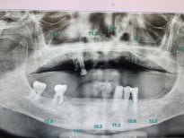Radiographie d’implant dentaire à Dential Dental Clinic montrant mâchoire et résultat