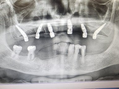 Résultat de pose d’implants dentaires en radiographie à Dential Dental Clinic, maxillaire