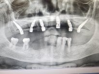 Résultat de pose d’implants dentaires en radiographie à Dential Dental Clinic, maxillaire