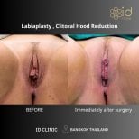Результаты до и после уменьшения малых губ и клитора в ID Clinic Bangkok