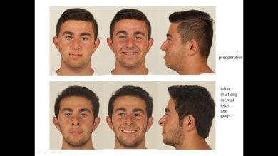 before-after photo jaw-shaping