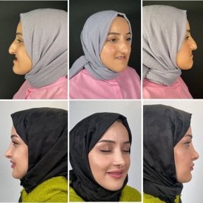 before-after photo jaw-shaping