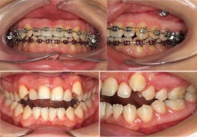 before-after photo jaw-shaping