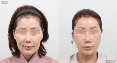 Before and after blepharoplasty results at AB Plastic Surgery, visible eyelid correction